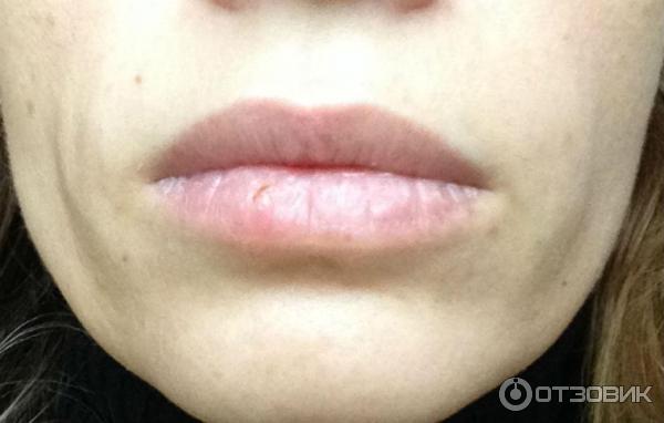 Инъекции Juvederm Ultra 3: фото через 2 дня после процедуры