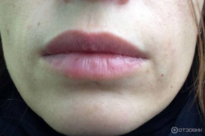 Инъекции Juvederm Ultra 3: фото сразу после процедуры