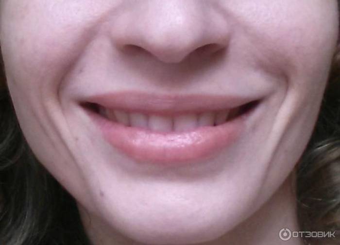Инъекции Juvederm Ultra 3: фото широкой улыбки после процедуры
