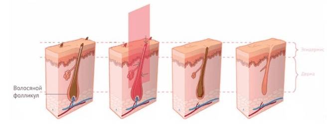 Схема работы диодного лазера