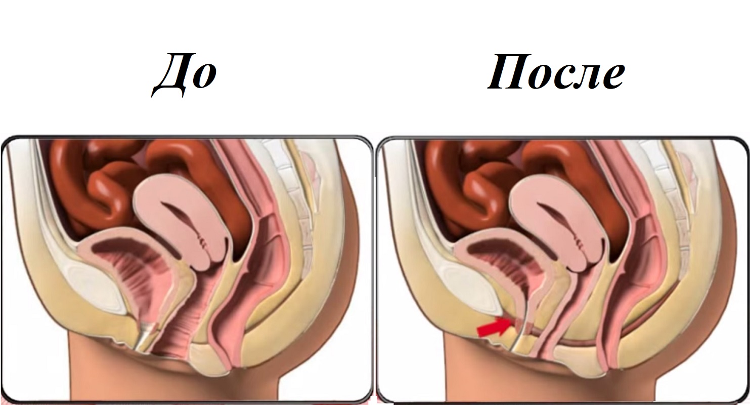 Интимные мышцы до и после гимнастики Кегеля