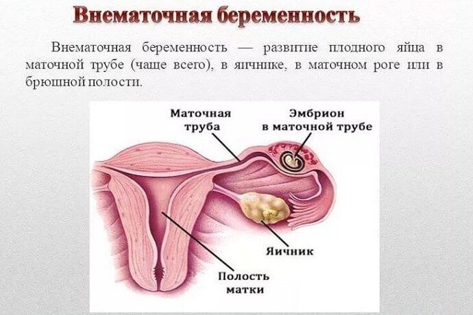 Внематочная беременность
