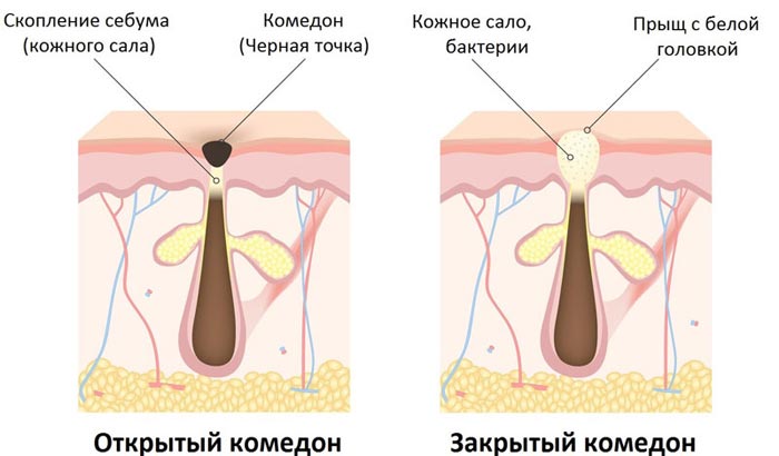 Открытые и закрытые комедоны