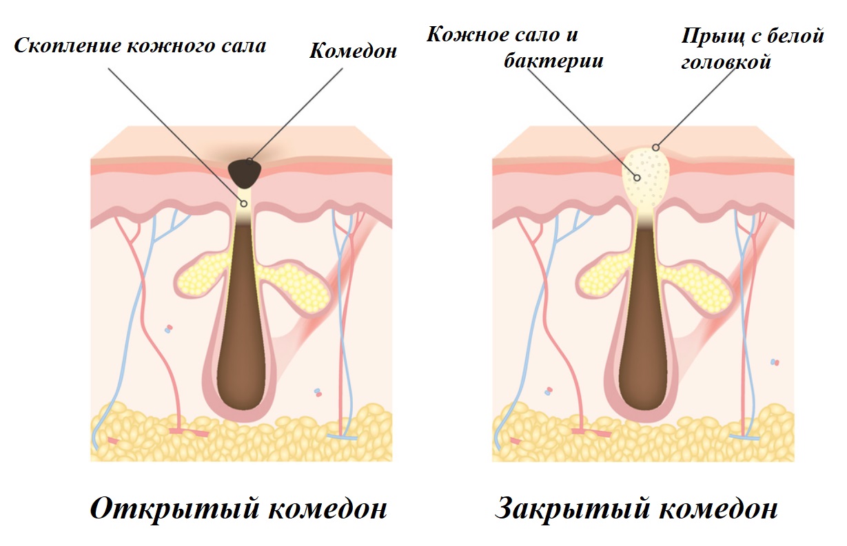 Виды комедонов