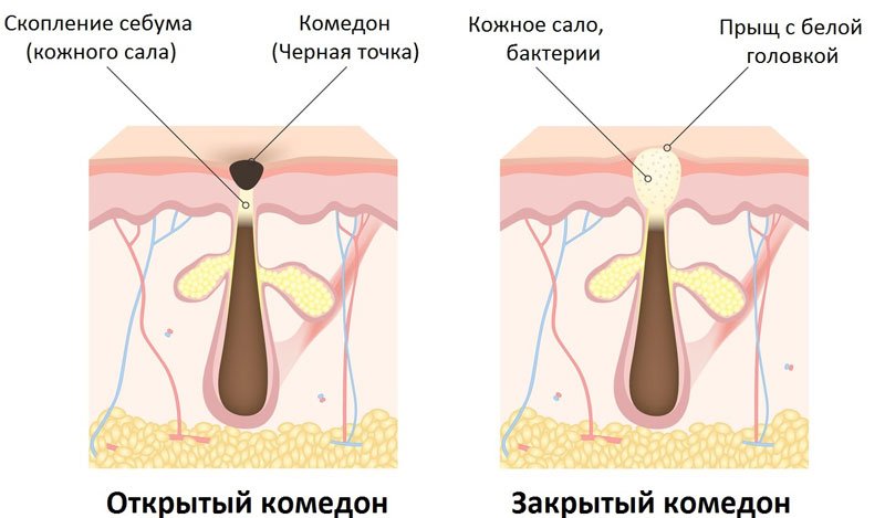 Открытый и закрытый комедоны