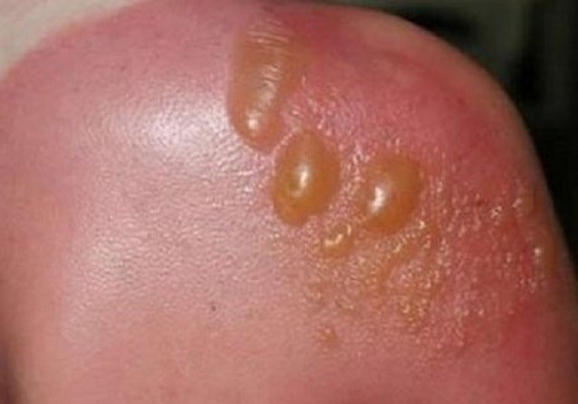 Волдыри после солярия