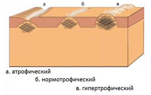 Типы шрамов