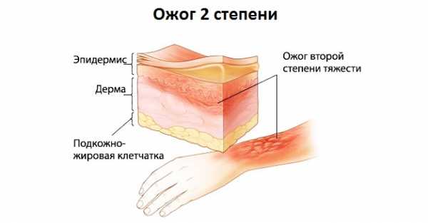 Схематичное изображение ожога второй степени