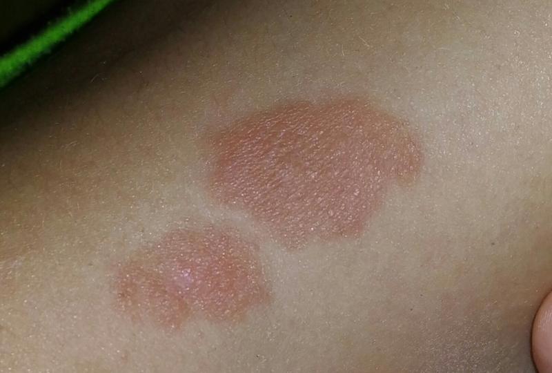 Тёмные пятна на месте ожогов