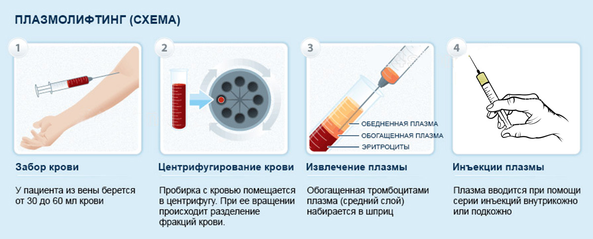 Этапы плазмолифтинга