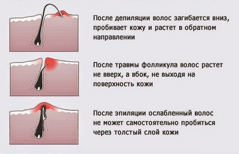 Процесс врастания волос