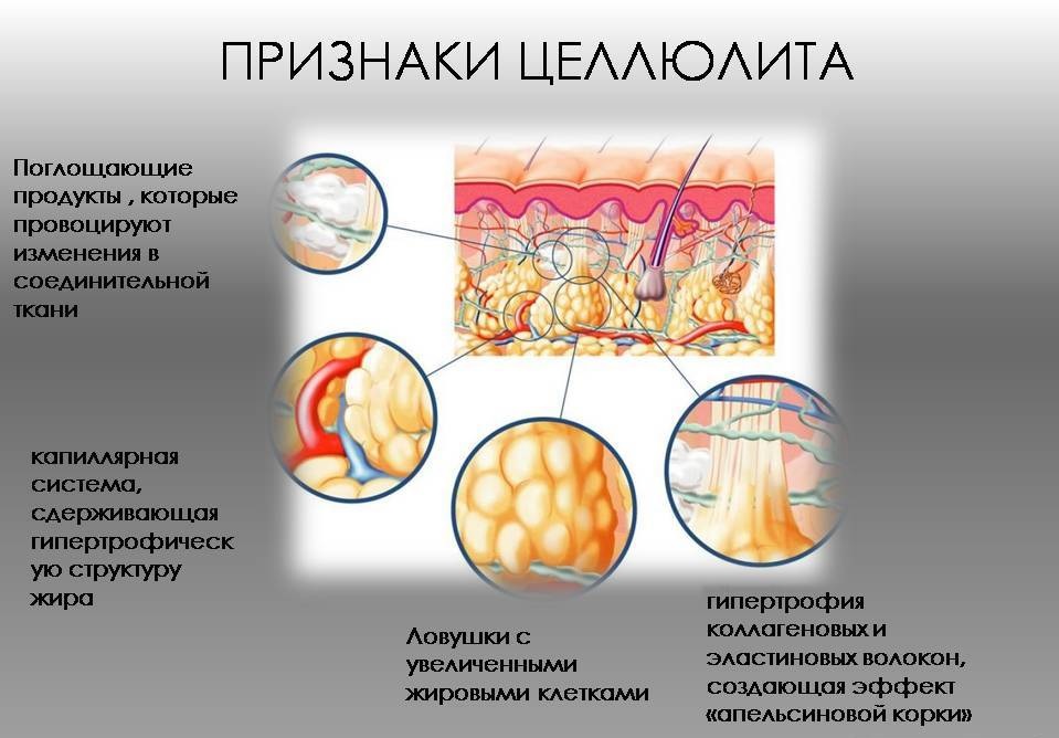 Признаки целлюлита