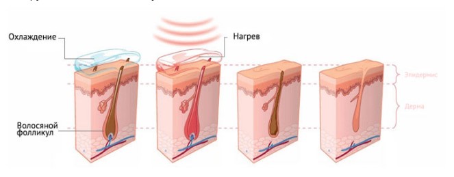 Схема работы александритового лазера