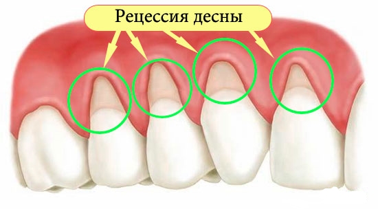 Рецессия