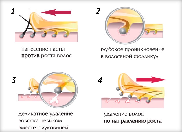 Сахарная депиляция