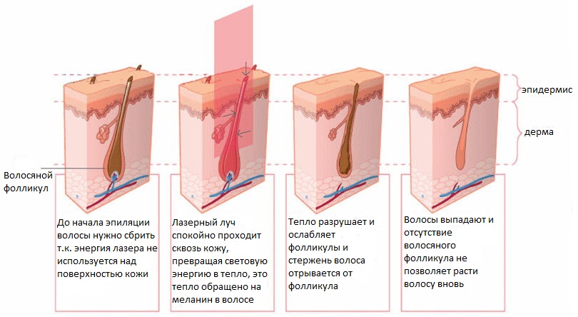 Схема воздействия лазера на фолликул
