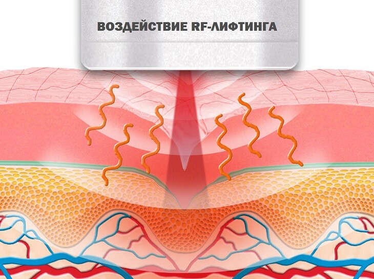 Схема действия радиочастотного излучения