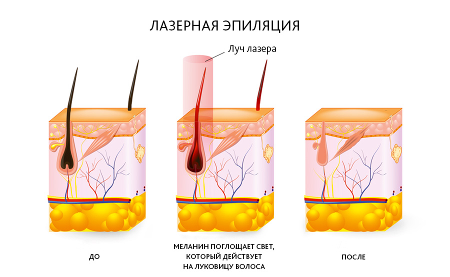 Схема лазерной эпиляции