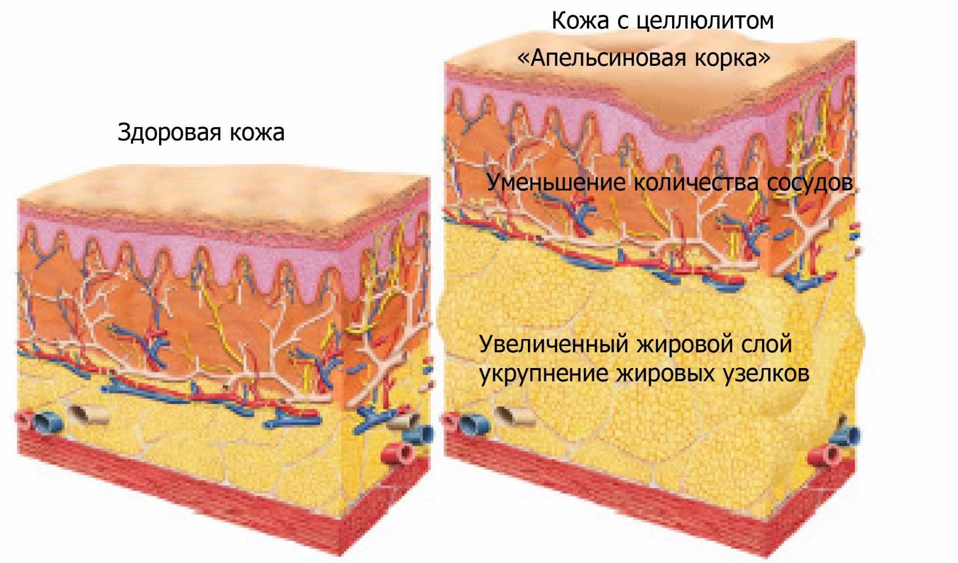Схема образования целлюлита