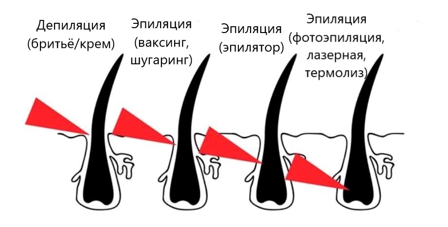 Как глубоко удаляют волос разные процедуры