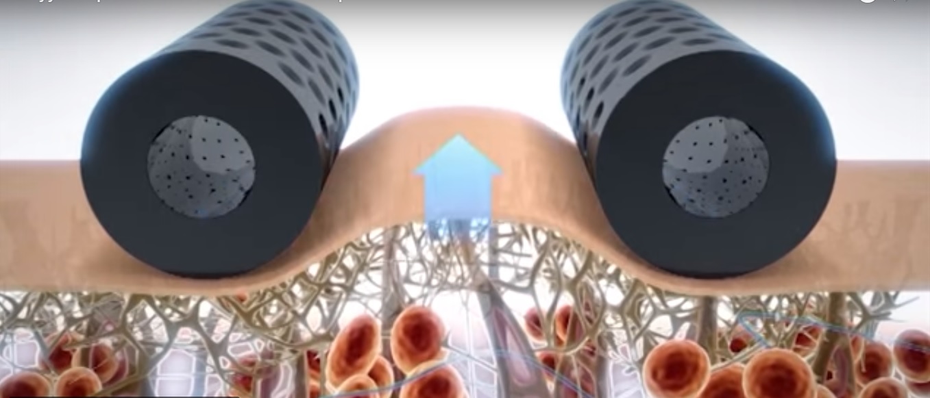 Схема воздействия вакуумно-роликового массажа на кожу