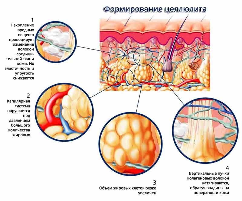 Схема возникновения целлюлита