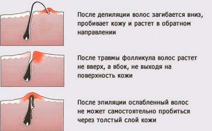 Схема врастания волоса