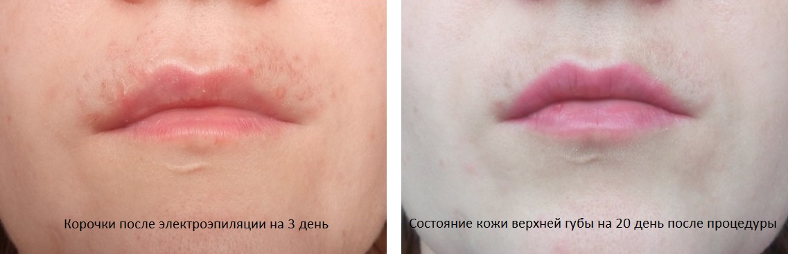 Состояние верхней губы после электроэпиляции