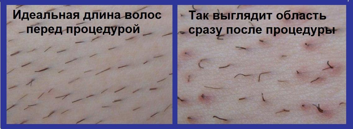 Состояние волос на теле до и после эпиляции