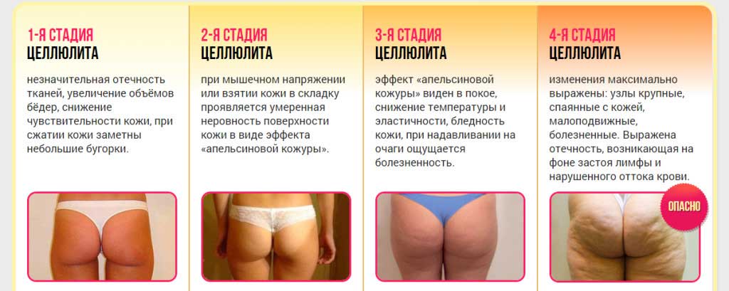 Стадии целлюлита
