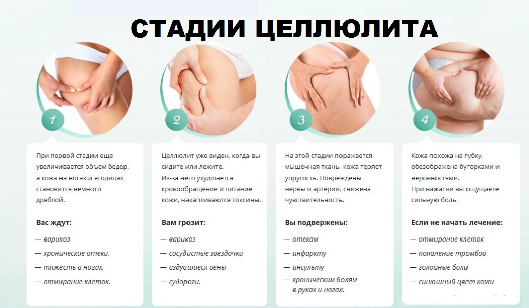 Стадии целлюлита