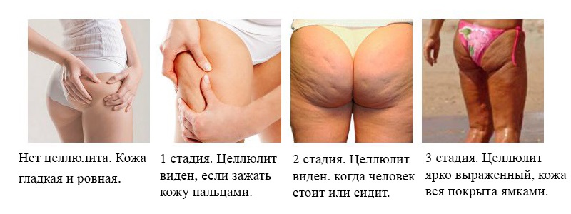 Стадии образования целлюлита