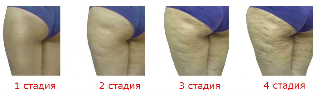 Стадии развития целлюлита