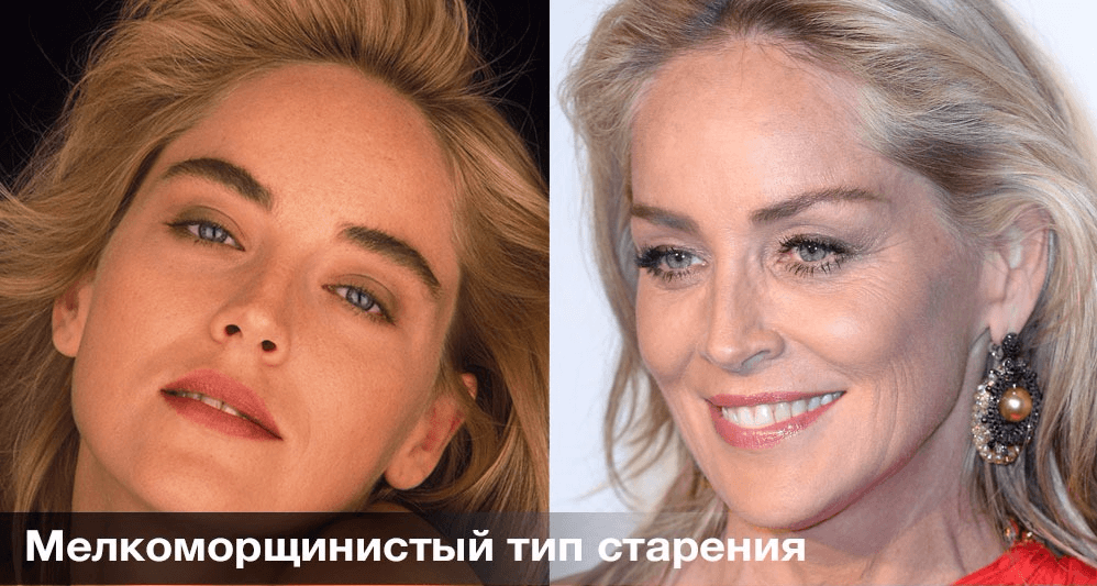 Тип старения «печёное яблочко»
