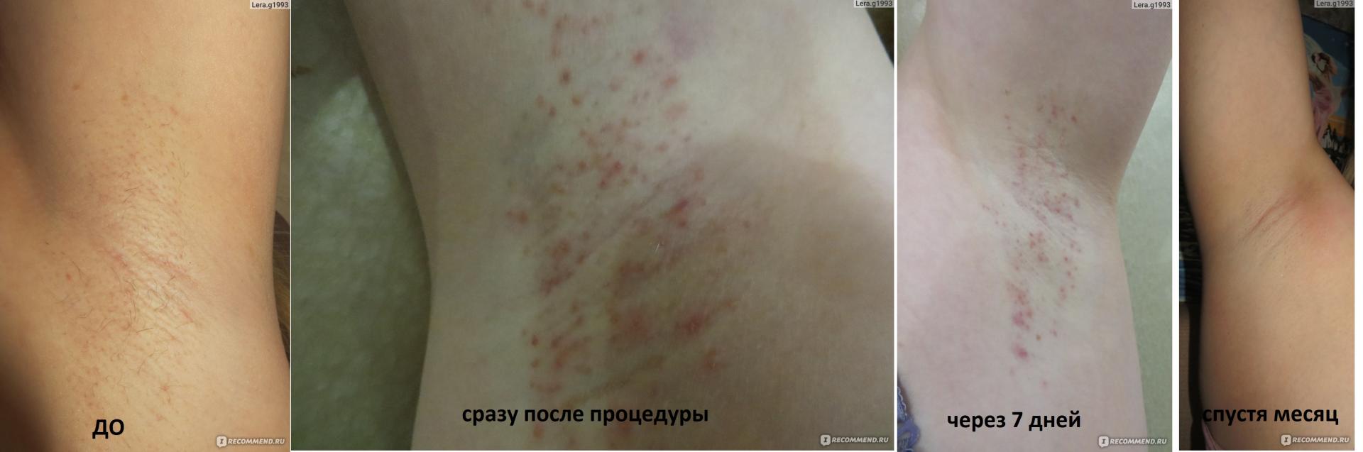 Удаление волос электроэпиляцией