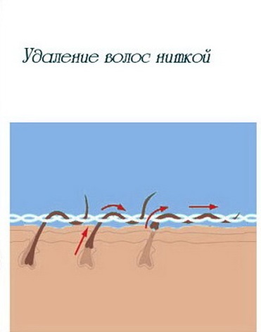 Удаление волос нитью