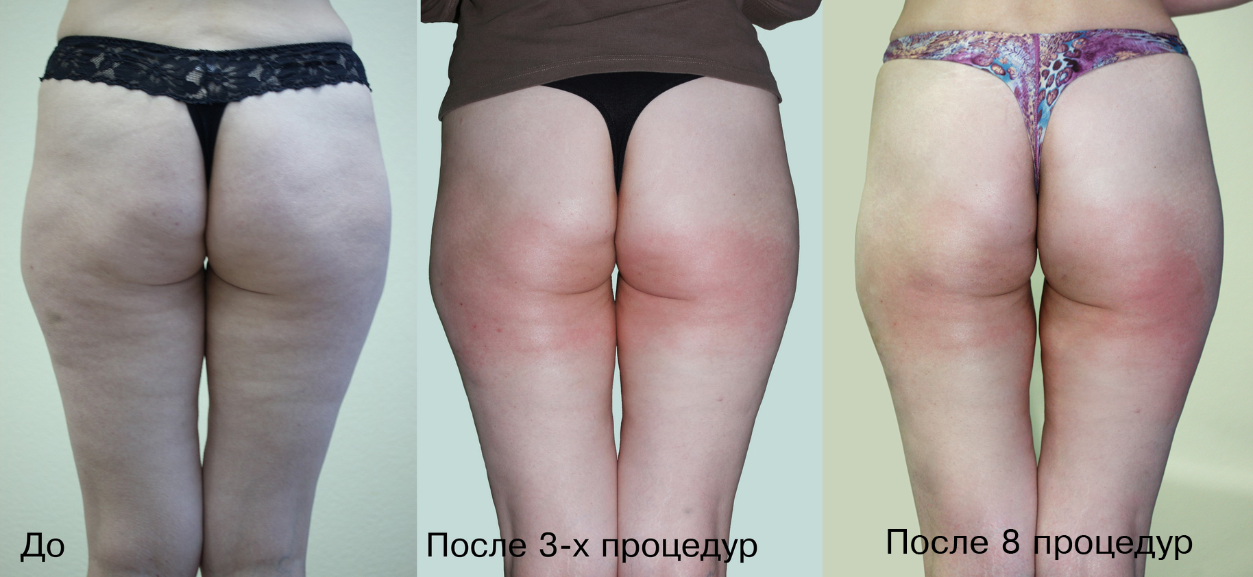 Вакуумный массаж фото до и после