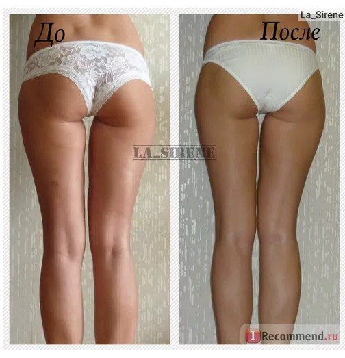 Вакуумный массаж в салоне фото до и после