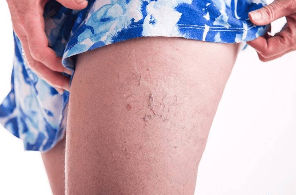 Варикозное расширение вен