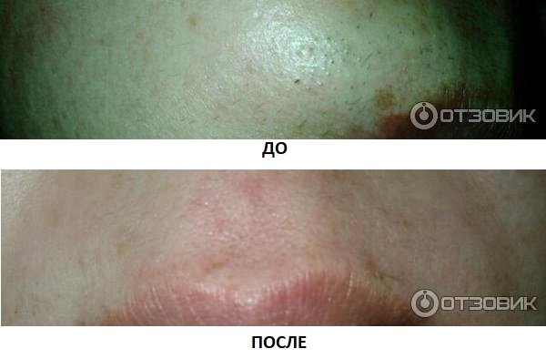 Верхняя губа ДО и ПОСЛЕ