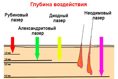 Виды лазеров для эпиляции