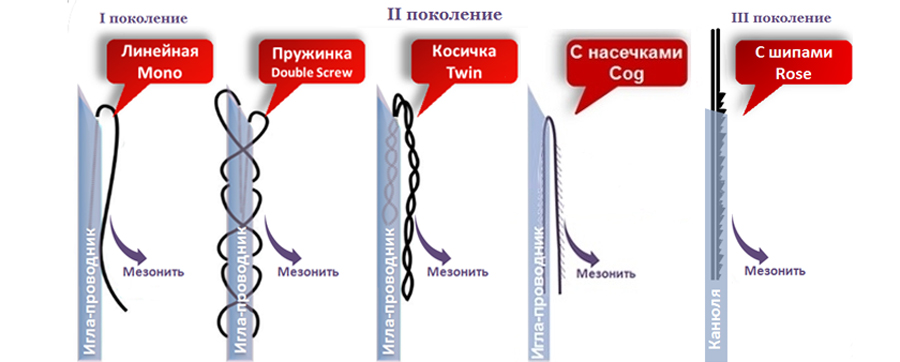 виды мезонитей