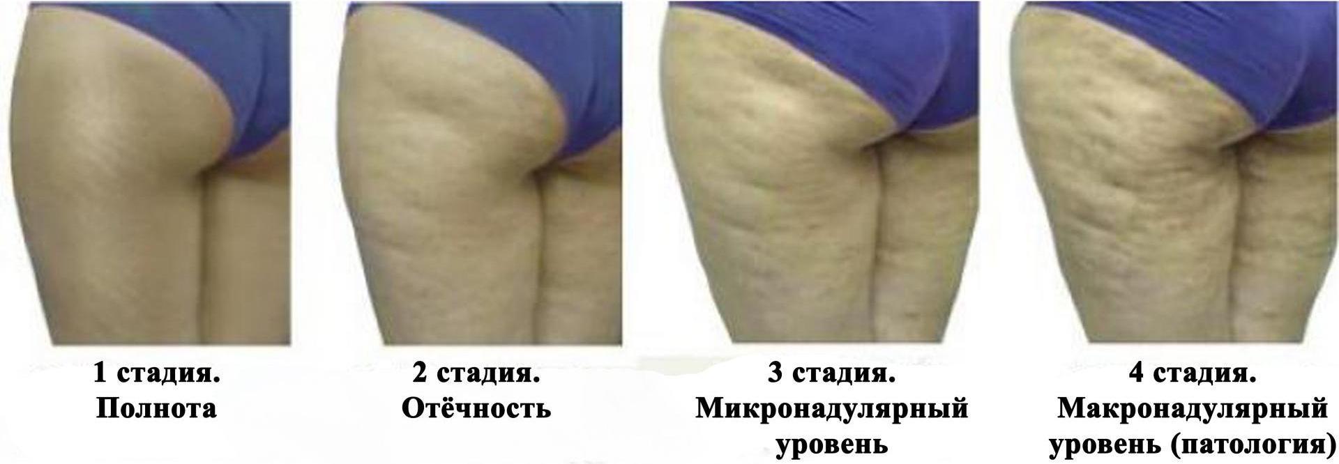 Внешний вид кожи при прогрессирующем целлюлите