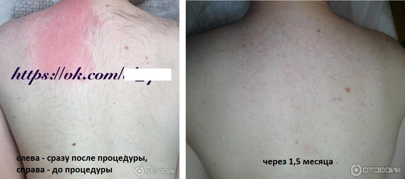 Волосы на спине
