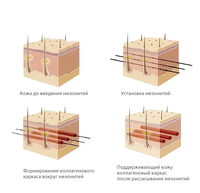 Принцип армирования кожи мезонитями