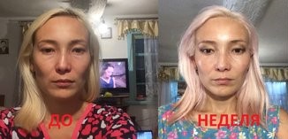 Результат ультразвуковой подтяжки