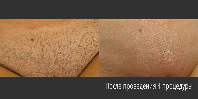 Зона бикини до и после фотоэпиляции