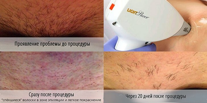 Зона бикини после нескольких сеансов лазерной эпиляции