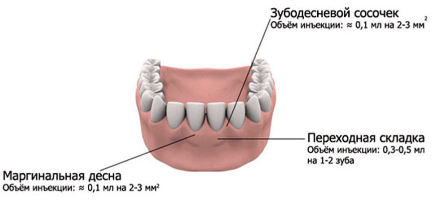 Зоны инъекций аутоплазмы